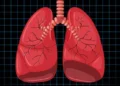 카자흐스탄, 폐암 조기 발견 위해 인공지능(AI) 도입 논의